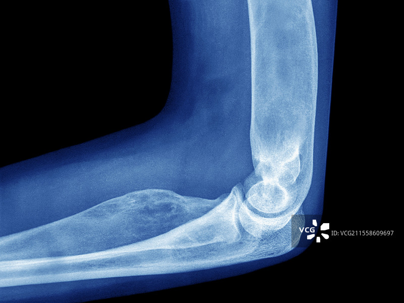 纤维性骨营养不良，X光片图片素材