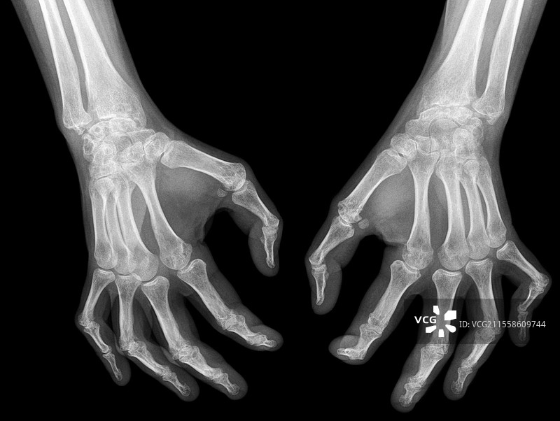 手部关节炎，X光片图片素材