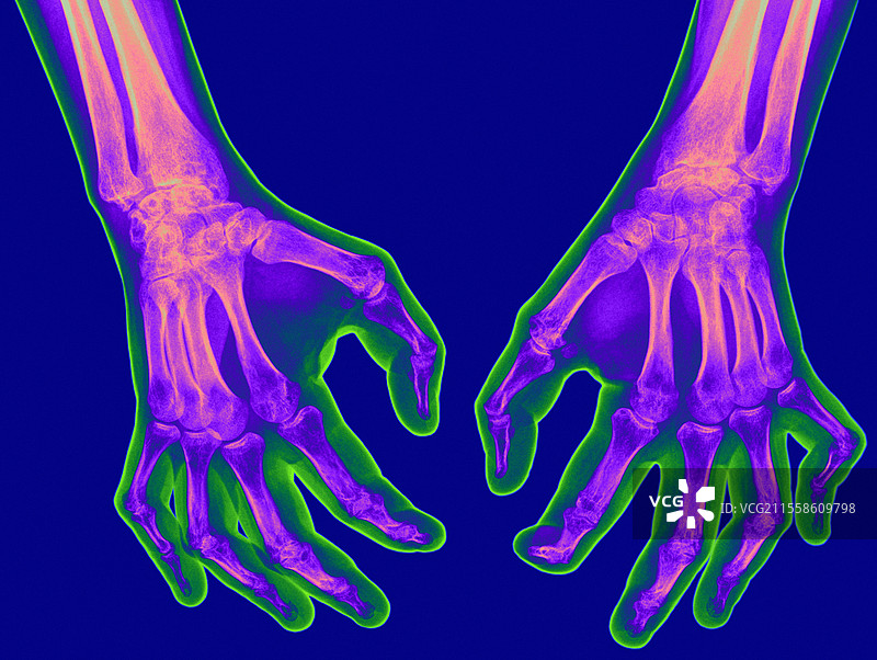 手部关节炎，X光片图片素材