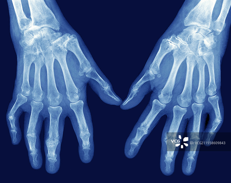 血色病，手，X光图片素材