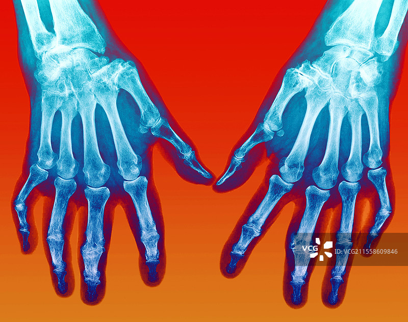 血色病，手，X光图片素材