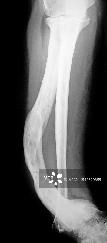 帕吉特病，手臂X光片图片素材