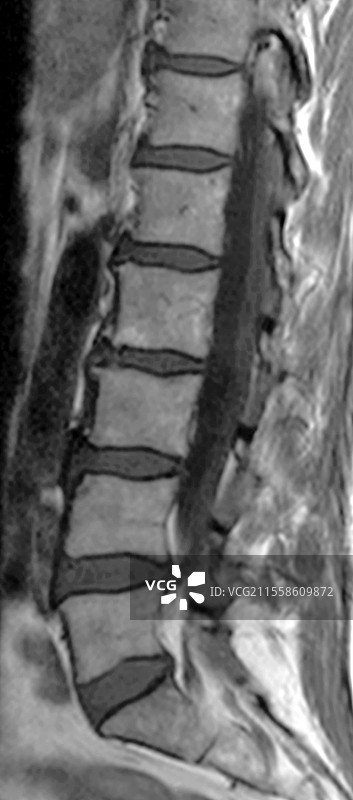 脊椎变形症，MRI扫描图片素材