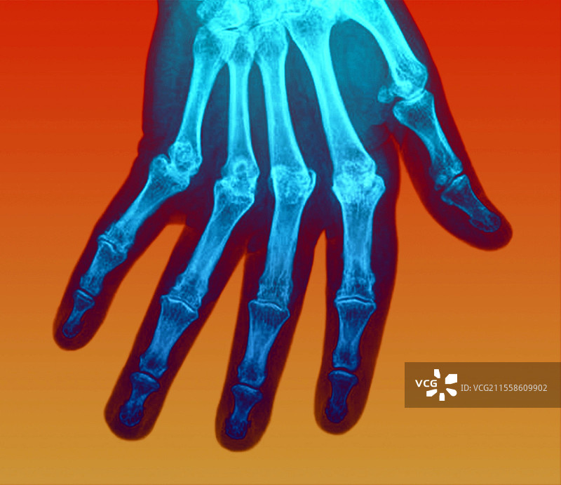 关节炎手部X光片图片素材