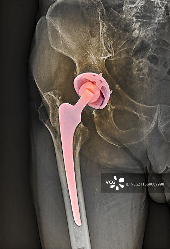 全髋关节置换术，X光片图片素材