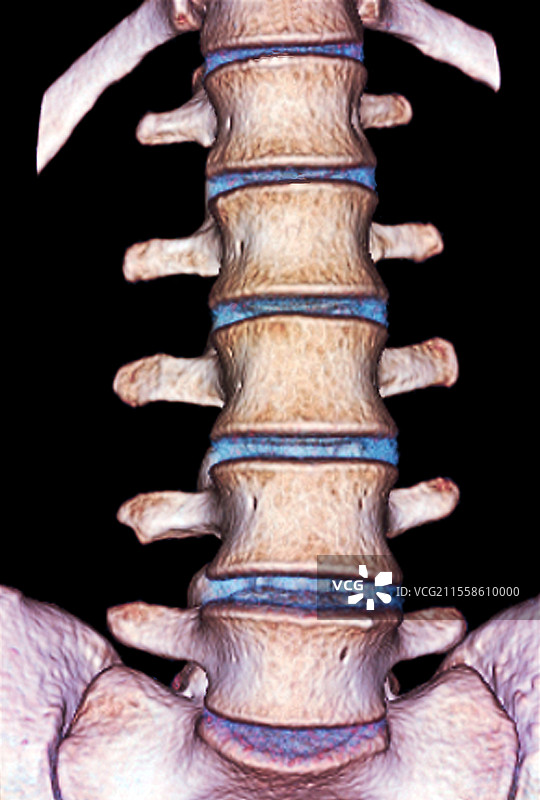 正常的腰椎，3D CT扫描图片素材