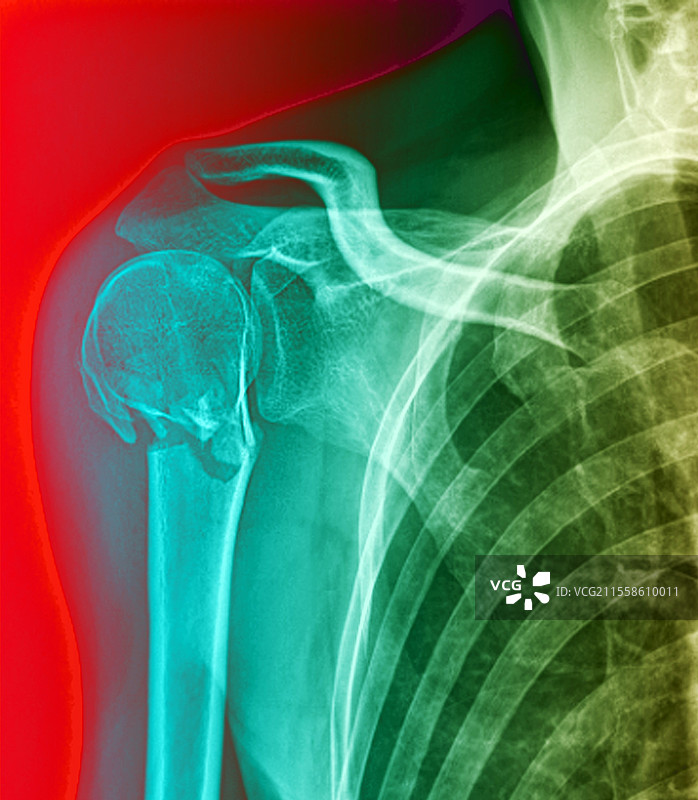 骨折的手臂，X光片图片素材