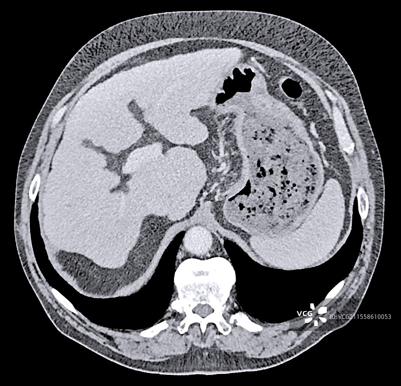 酒精性肝硬化，CT扫描图片素材