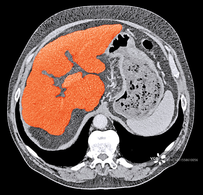 酒精性肝硬化，CT扫描图片素材
