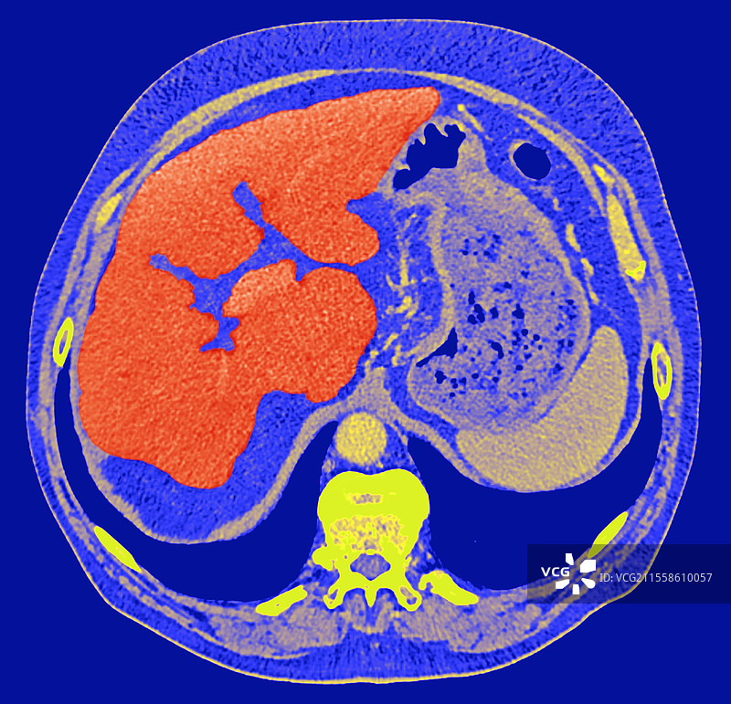 酒精性肝硬化，CT扫描图片素材