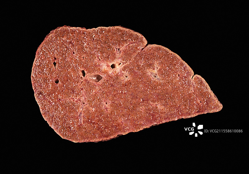 肝硬化图片素材