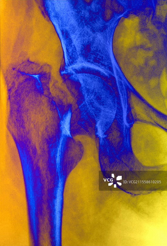 骨质疏松性髋部骨折，X光片图片素材
