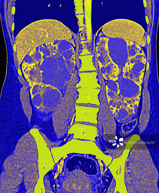 多囊肾，CT扫描图片素材