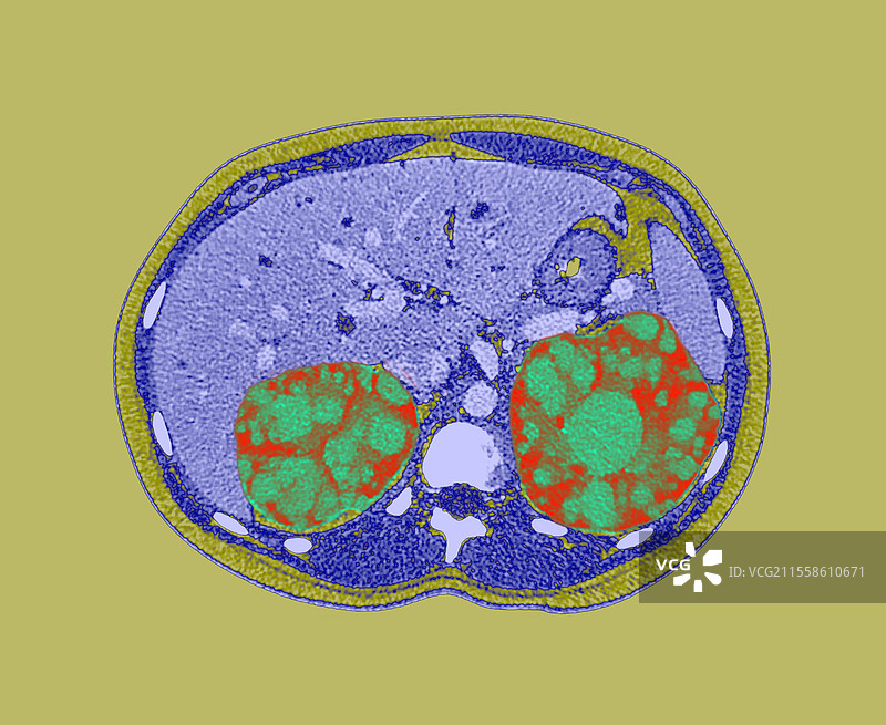 多囊肾，CT扫描图片素材