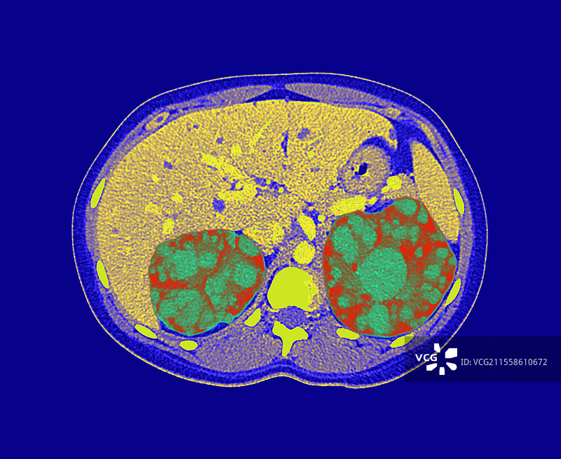 多囊肾，CT扫描图片素材