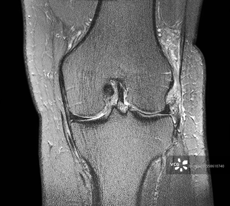 正常膝关节，MRI扫描图片素材