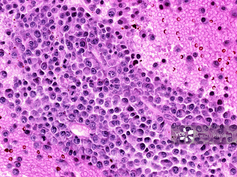 骨癌，光学显微镜图像图片素材