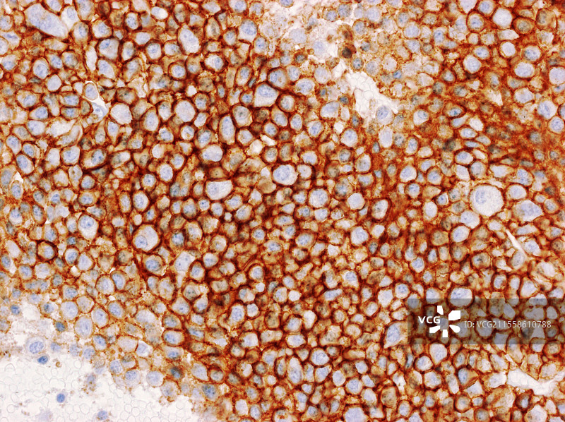 多发性骨髓瘤，光学显微镜图像图片素材