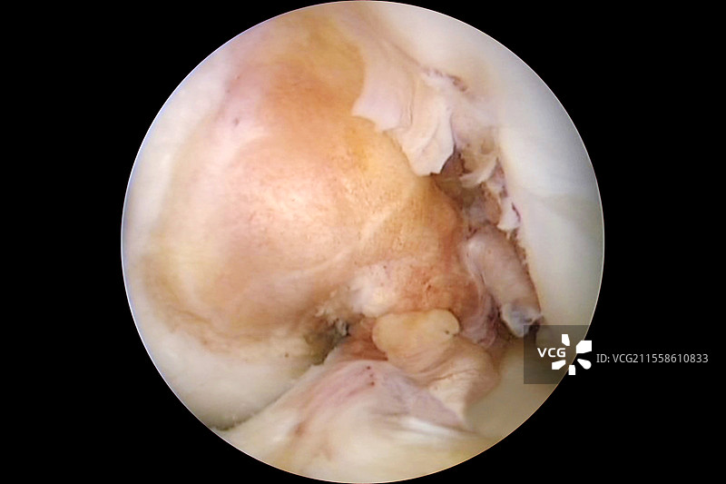膝关节韧带撕裂，内窥镜检查图片素材