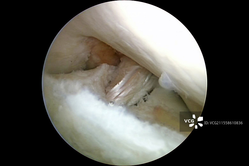 修复的膝关节韧带断裂图片素材