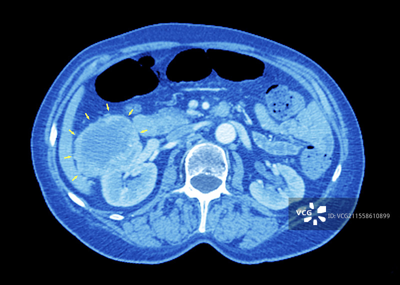 肾癌，CT扫描图片素材