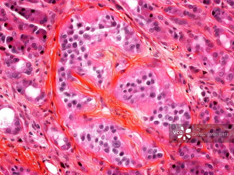 糖尿病中的淀粉样变，光学显微镜图像图片素材
