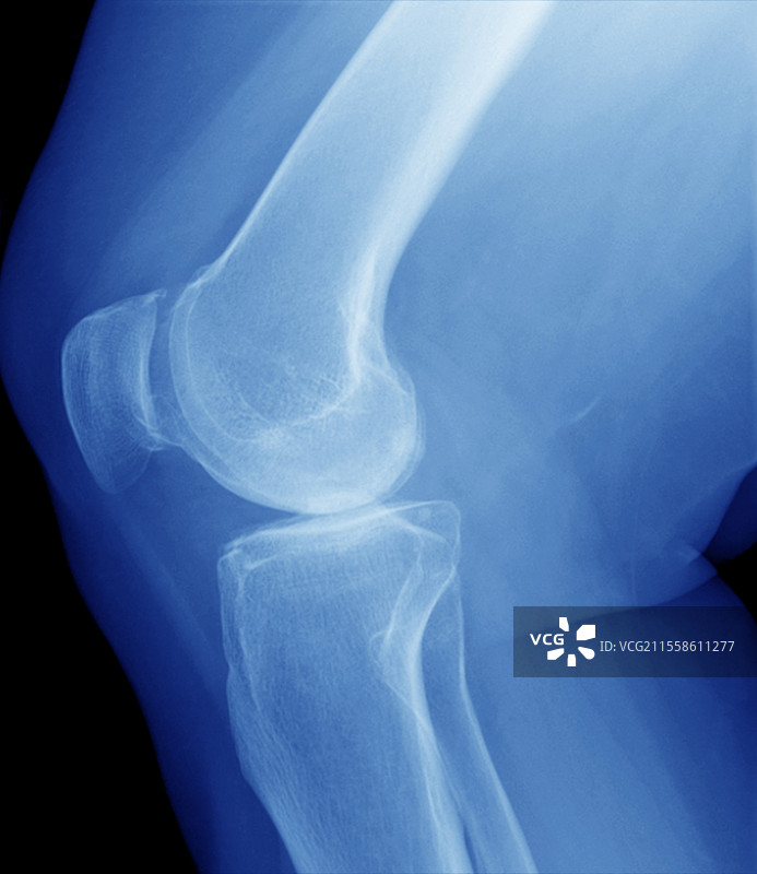 膝关节骨关节炎，X光片图片素材