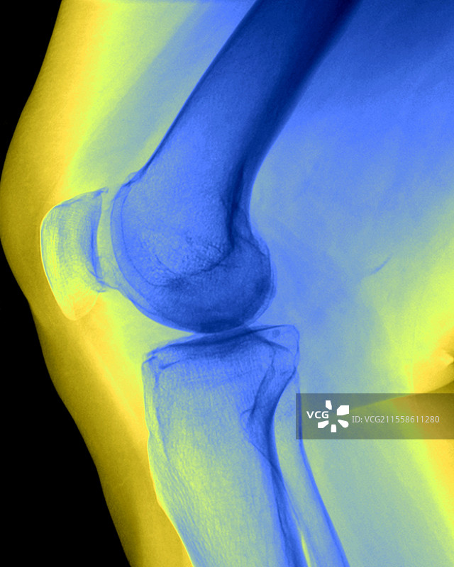 膝关节骨关节炎，X光片图片素材