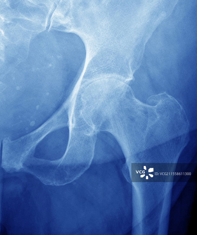 髋关节骨关节炎图片素材