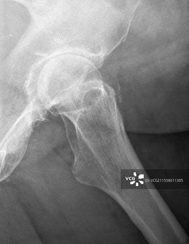 髋关节骨关节炎图片素材