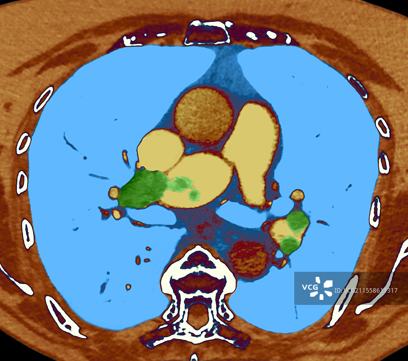 急性肺栓塞，CT扫描图片素材