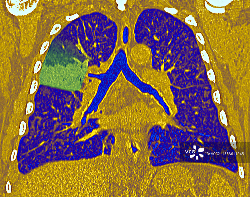 肺炎球菌性肺炎，CT扫描图片素材