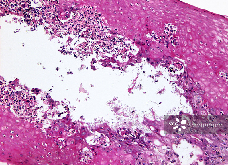 嗜酸性食管炎，显微镜图像图片素材