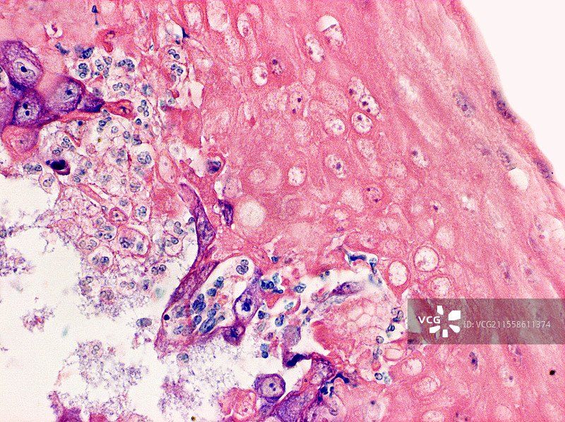 嗜酸性食管炎，显微镜图像图片素材