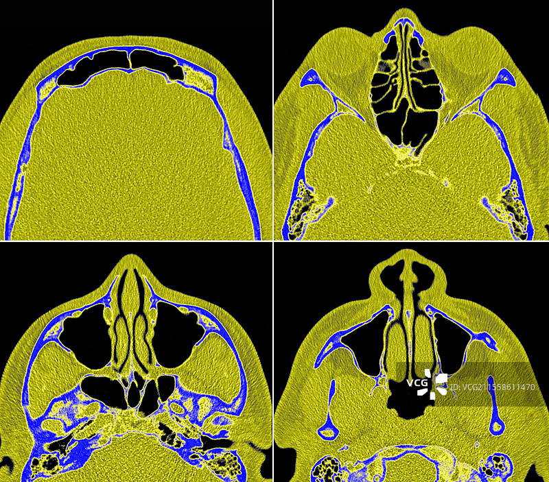 正常的鼻窦，CT扫描图片素材