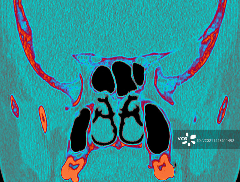 正常的鼻窦，CT扫描图片素材