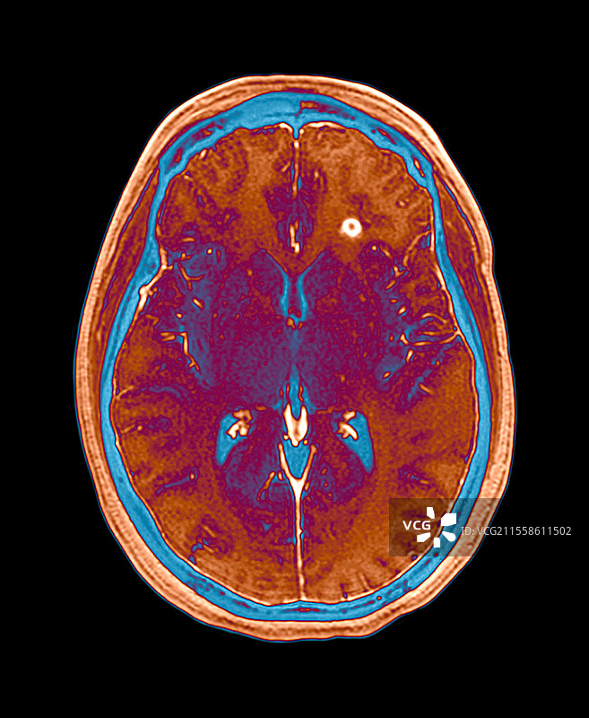 多发性硬化症的脑部MRI扫描图片素材