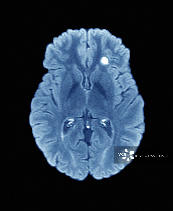 多发性硬化症中的大脑，MRI扫描图片素材