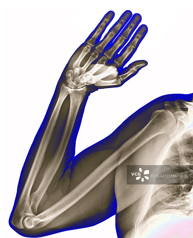健康的手臂，X光片图片素材