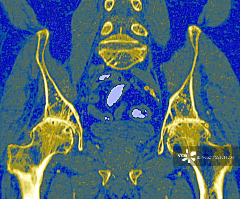 双侧髋关节骨关节炎，CT扫描图片素材