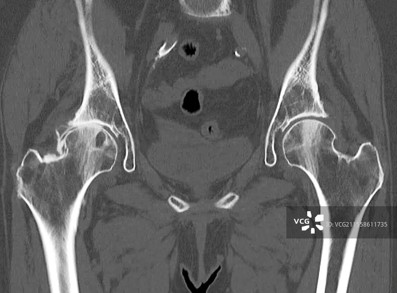 右侧髋关节骨关节炎，CT扫描图片素材