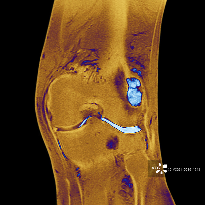 膝关节骨关节炎，MRI扫描图片素材