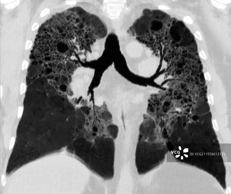 超敏性肺炎的肺部CT扫描图片素材