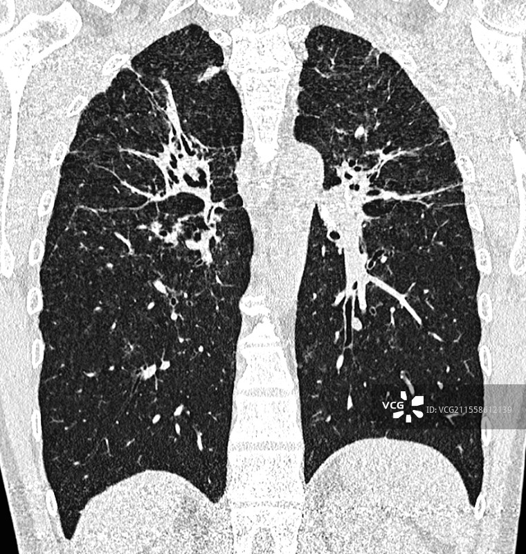 纤维性肺部肉芽肿病，CT扫描图片素材