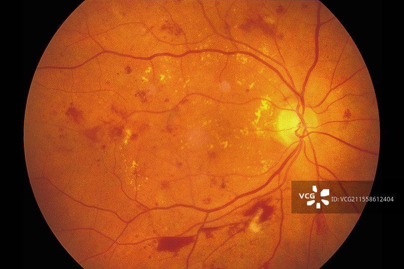 糖尿病视网膜病变，眼底图像图片素材