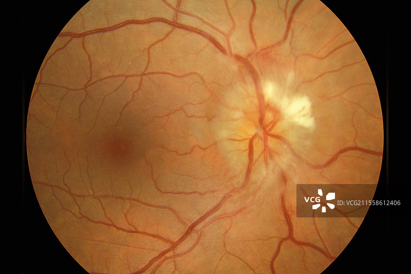 视盘水肿，眼底图像图片素材