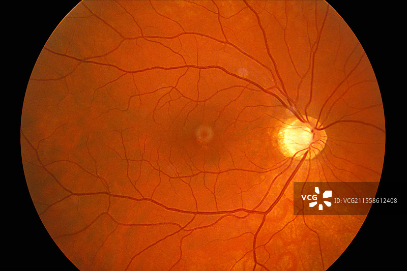 青光眼，眼底图像图片素材