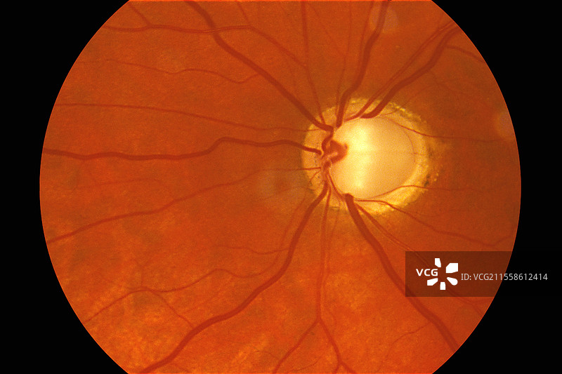 青光眼，眼底图像图片素材