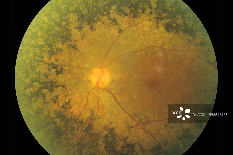 色素性视网膜病，眼底图像图片素材