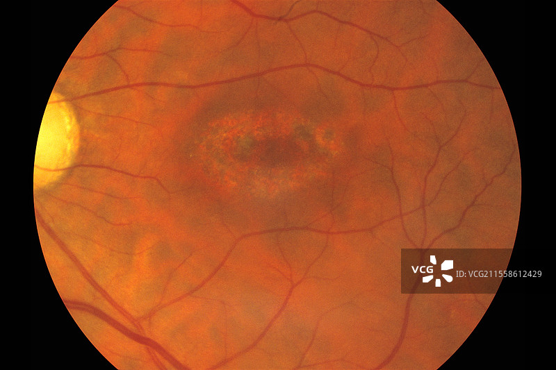 斯塔加特病，眼底图像图片素材